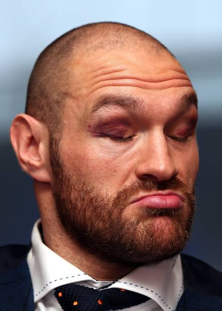 La smorfia di Tyson Fury, nuovo re dei pesi massimi, durante la sua conferenza stampa. (Getty Images)